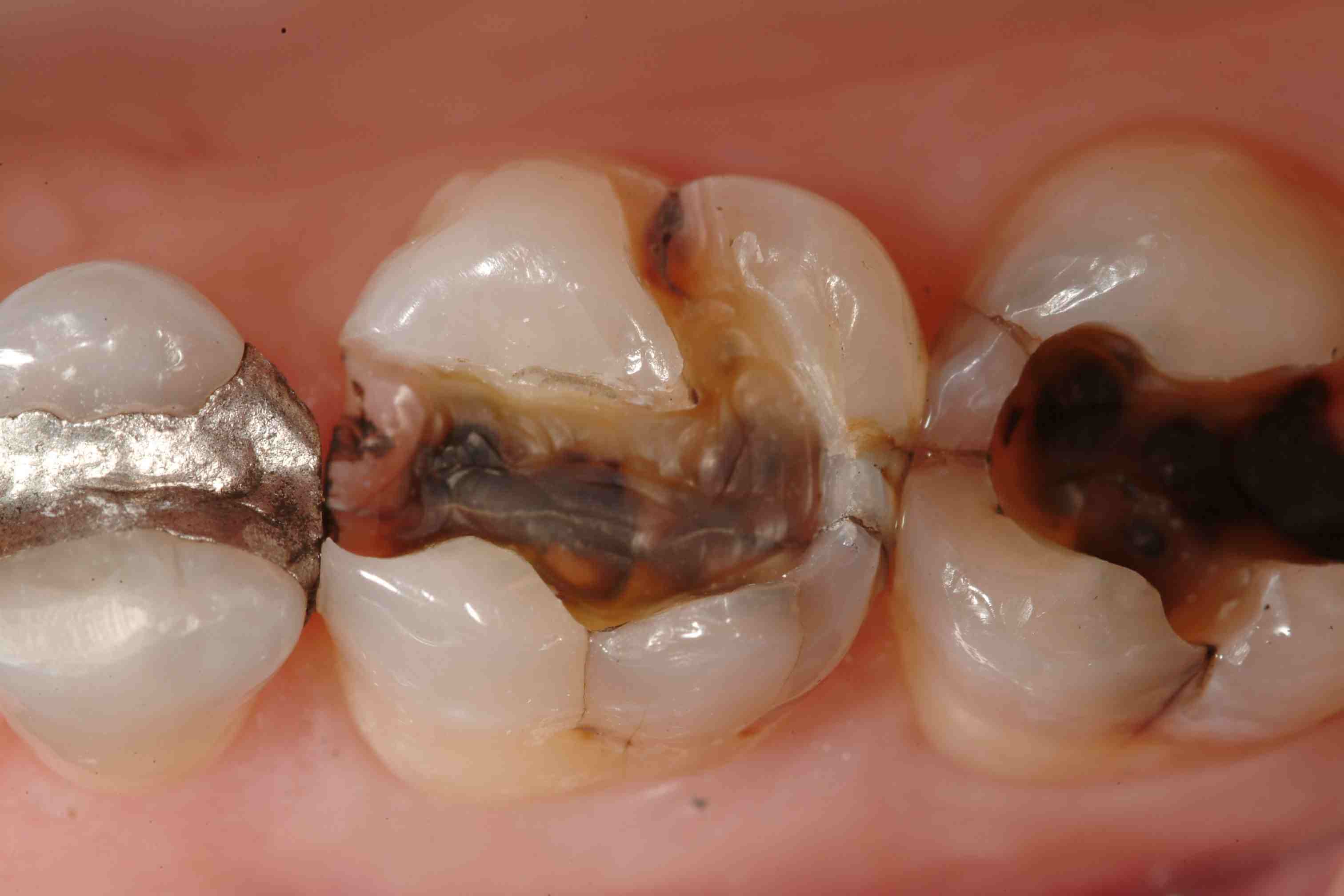Article about Cracked tooth: Types, causes, and treatments